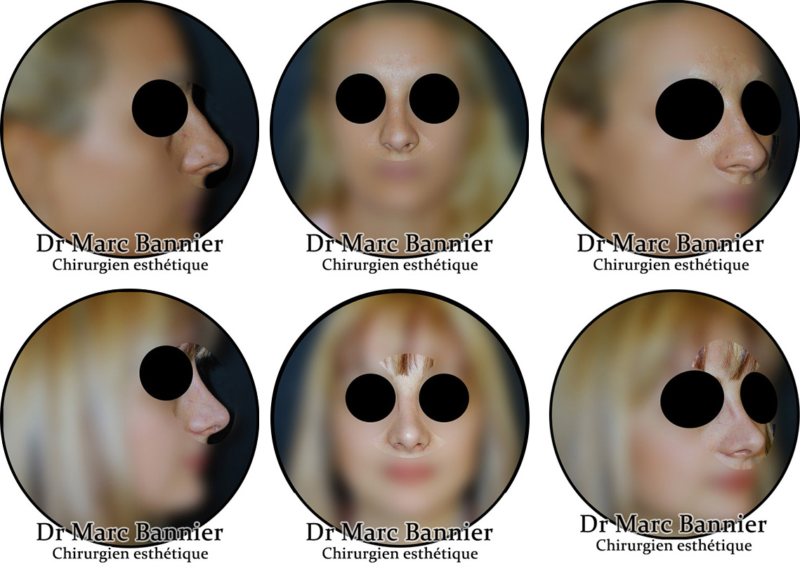 Exemples de Rhinoplastie Avant et Après